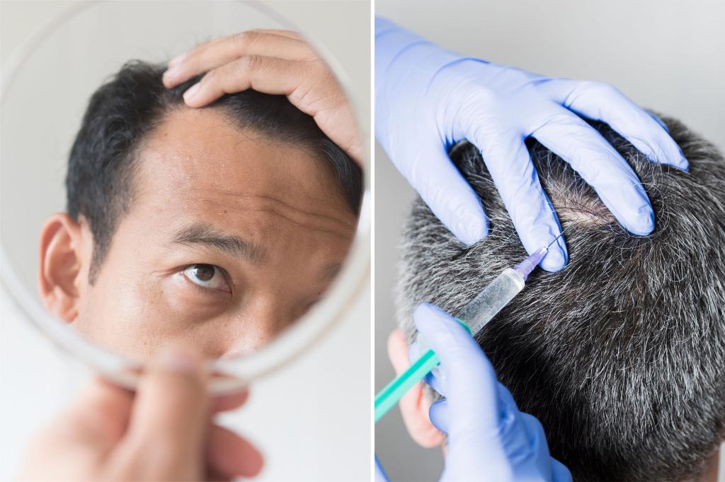 Men going bald turn to ‘new Botox’ for hair loss treatment