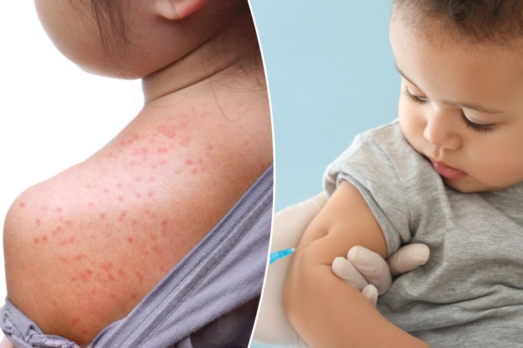 Doc warns against ’70s trend making a comeback amid measles outbreaks