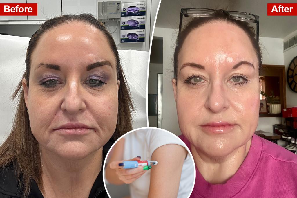 People with ‘Ozempic face’ are doing this to fight wrinkles and sagging
