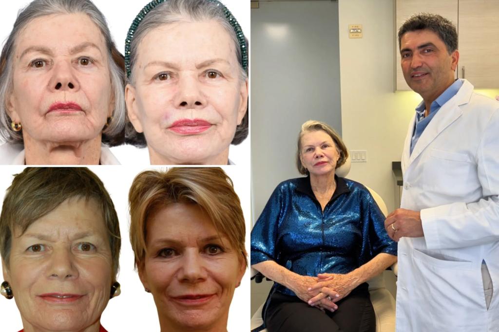 New Yorkers are getting second and third facelifts in quest for youth