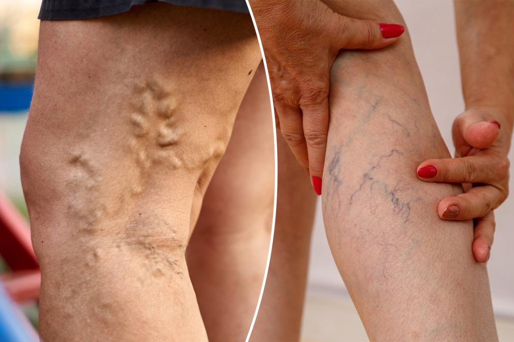 Varicose veins and spider veins are different — how to prevent them