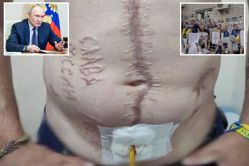 Ukrainian soldier branded with ‘Glory to Russia’ burned on his skin